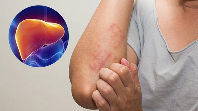 4 dấu hiệu cảnh báo gan của bạn không tốt, 3 nhóm người này cần giải độc gan để phòng bệnh - Ảnh 3. 4 dấu hiệu cảnh báo gan của bạn không tốt, 3 nhóm người này cần giải độc gan để phòng bệnh - Ảnh 3.