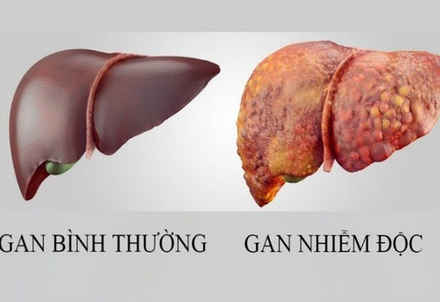 4 dấu hiệu cảnh báo gan của bạn không tốt, 3 nhóm người này cần giải độc gan để phòng bệnh - Ảnh 2. 4 dấu hiệu cảnh báo gan của bạn không tốt, 3 nhóm người này cần giải độc gan để phòng bệnh - Ảnh 2.