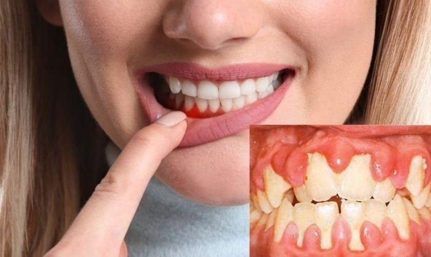 5 cách điều trị viêm nướu tại nhà- Ảnh 1. Viêm nướu răng bao lâu thì khỏi? Cách điều trị hiệu quả