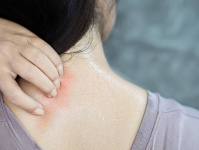 7 biện pháp giúp giảm ngứa da mùa hè- Ảnh 1. 7 biện pháp giúp giảm ngứa da mùa hè- Ảnh 1.