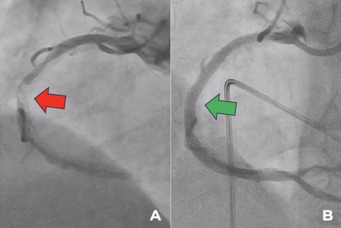 Động mạch vành phải hẹp từ đoạn gần đến đoạn xa gây giới hạn dòng chảy (hình A) và sau khi được đặt stent tái thông (hình B). Ảnh: Bệnh viện Tâm Anh