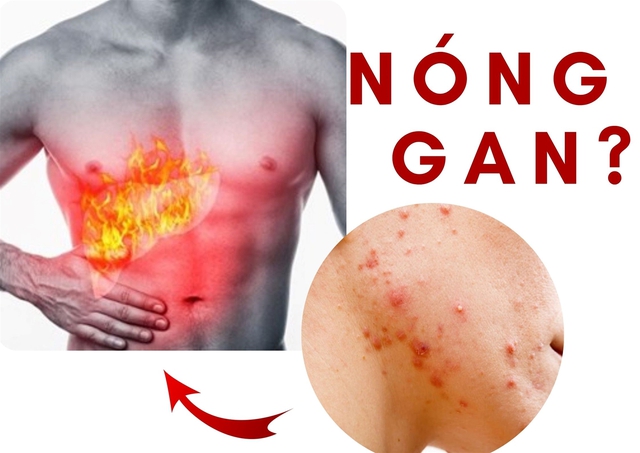 Nóng gan nguy hiểm thế nào? Làm gì để 'giải nhiệt' cho gan trong ngày nắng nóng - Ảnh 2. Nóng gan nguy hiểm thế nào? Làm gì để 'giải nhiệt' cho gan trong ngày nắng nóng - Ảnh 2.