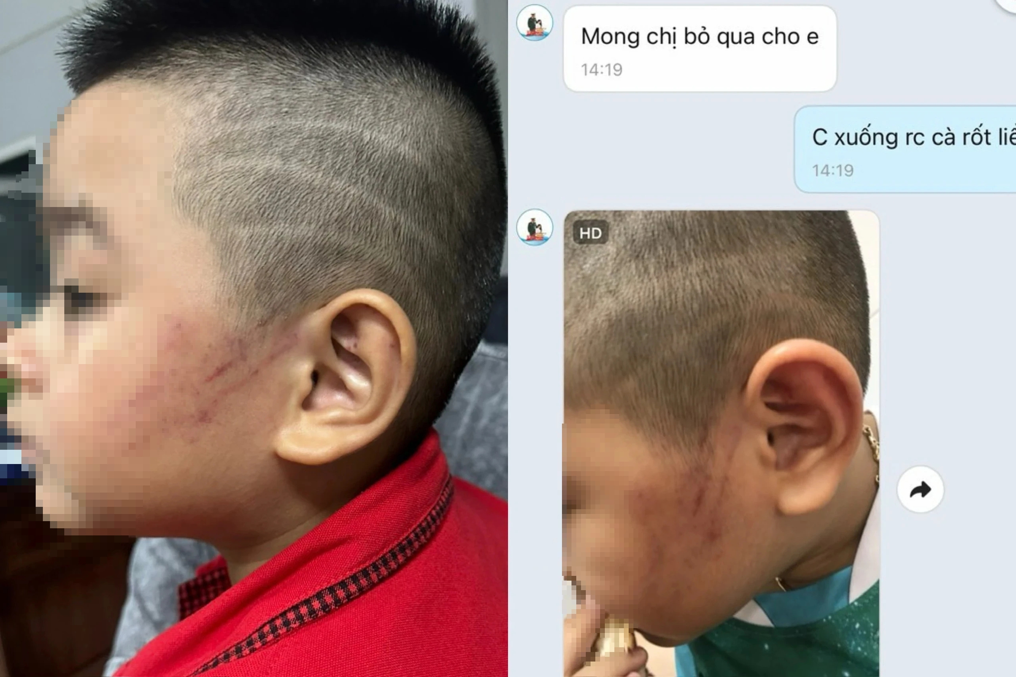 Phụ huynh tố giáo viên mầm non đánh con 5 tuổi tím mặt vì 'bé ngủ ngáy'- Ảnh 1. Hình ảnh bé Kh. bầm tím mặt và tin nhắn xin lỗi phụ huynh từ cô giáo