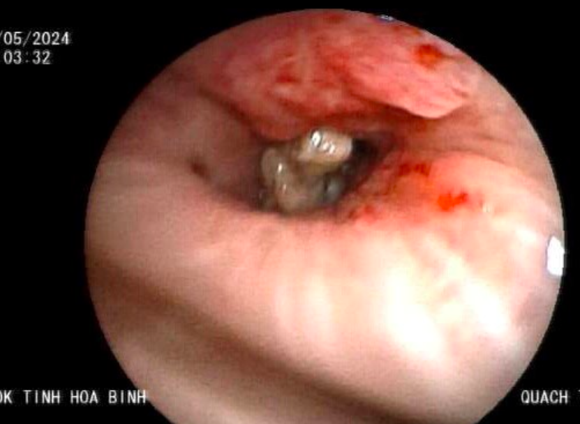 Sự cố khi ăn cơm khiến người phụ nữ ho ra máu, phải đi cấp cứu - Ảnh 1.