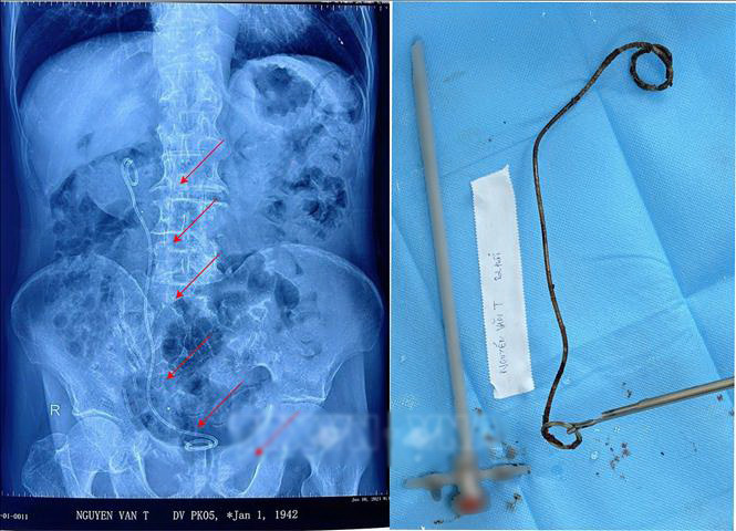 Ống sonde hơn 20cm 'ngủ quên' trong thận - bàng quang cụ ông 82 tuổi- Ảnh 2. Ống thông sonde JJ dài hơn 20cm đã đổi màu đen, bám đầy sỏi sau khi được lấy ra khỏi người bệnh nhân - Ảnh: TTXVN phát