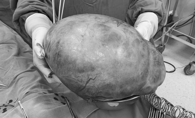 Nữ bệnh nhân 57 tuổi mang khối u buồng trứng nặng đến 7kg vì tâm lý chủ quan phụ nữ Việt hay mắc phải- Ảnh 2. Nữ bệnh nhân 57 tuổi mang khối u buồng trứng nặng đến 7kg vì tâm lý chủ quan phụ nữ Việt hay mắc phải- Ảnh 2.