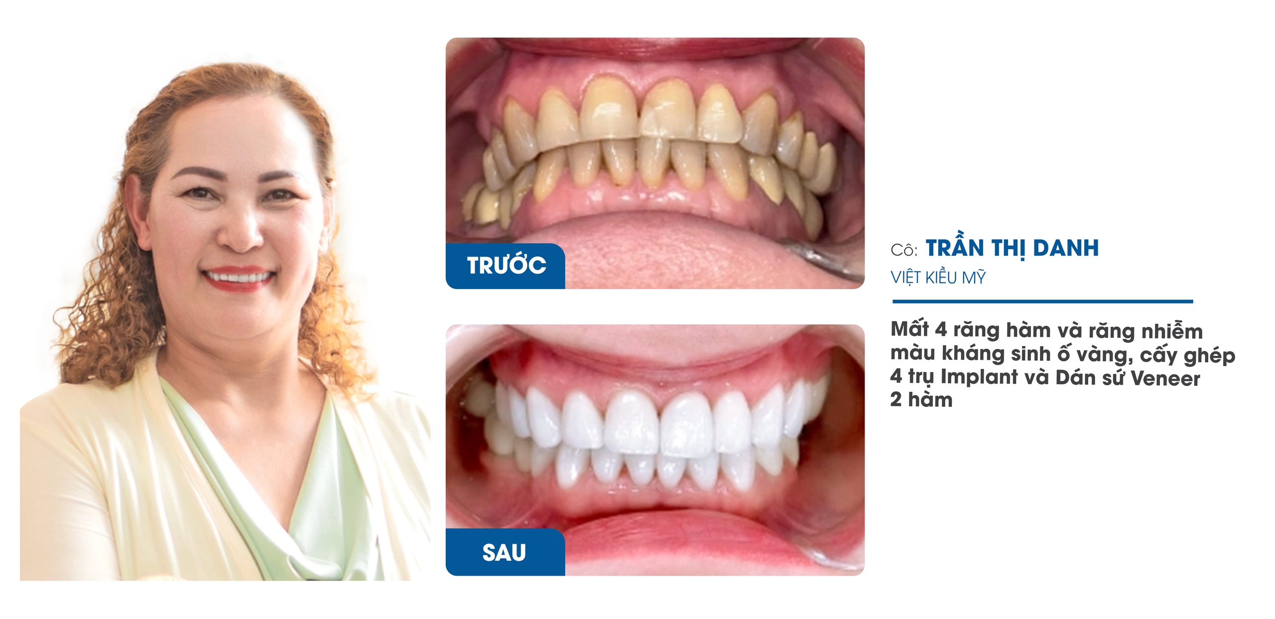 Nha Khoa Răng Sứ I-Dent Diamondtech ứng dụng công nghệ Digital Smile Design trong thiết kế nụ cười- Ảnh 3. Nha Khoa Răng Sứ I-Dent Diamondtech ứng dụng công nghệ Digital Smile Design trong thiết kế nụ cười- Ảnh 3.