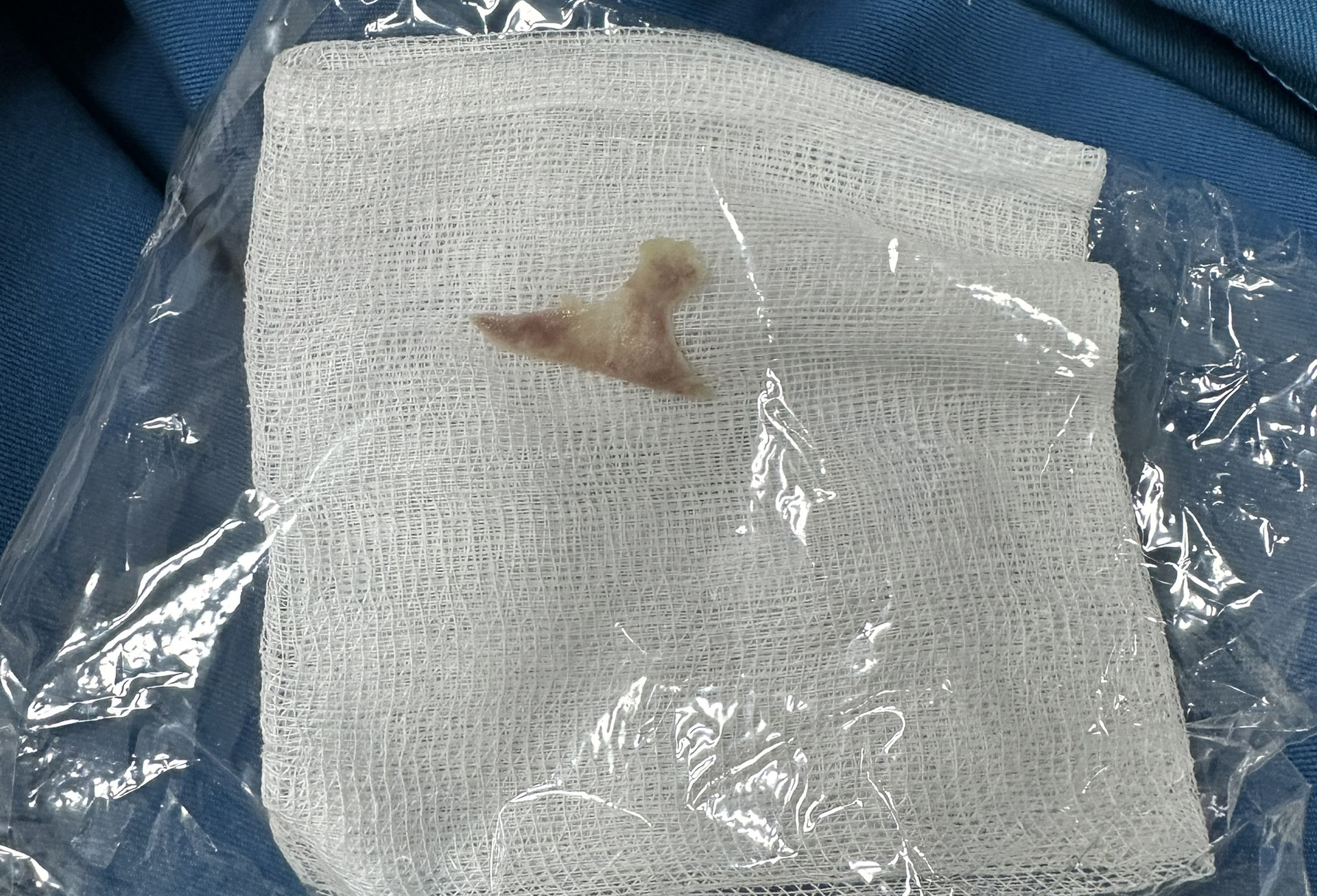 Bé gái 5 tuổi bị xương gà đâm xuyên thành thực quản- Ảnh 2. Bé gái 5 tuổi bị xương gà đâm xuyên thành thực quản- Ảnh 2.