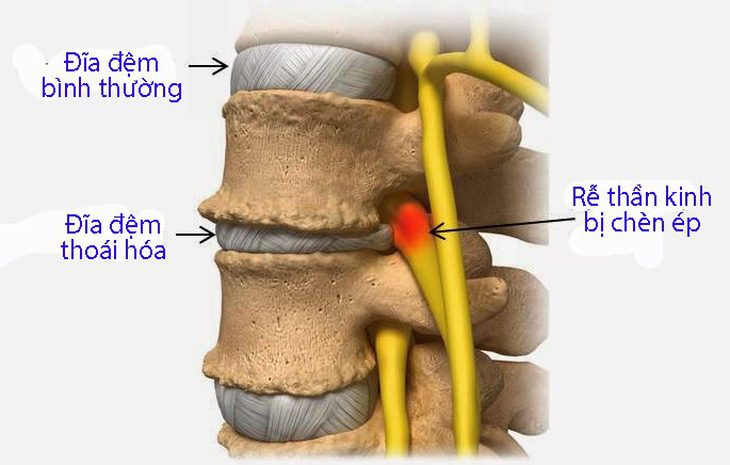 Chỉ cần đi bộ thường xuyên có thể giúp ngừa đau thắt lưng- Ảnh 3. Bệnh đau thắt lưng