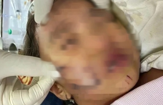 Đang chơi, bé gái 11 tuổi ở Phú Thọ bất ngờ bị chó hàng xóm cắn trọng thương vùng đầu, gáy- Ảnh 2. Đang chơi, bé gái 11 tuổi ở Phú Thọ bất ngờ bị chó hàng xóm cắn trọng thương vùng đầu, gáy- Ảnh 2.