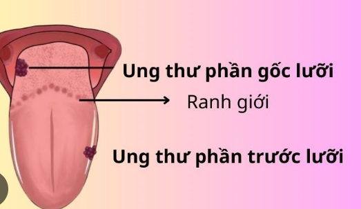 Người bệnh ung thư lưỡi nên tập luyện như thế nào?- Ảnh 1. Người bệnh ung thư lưỡi nên tập luyện như thế nào?- Ảnh 1.
