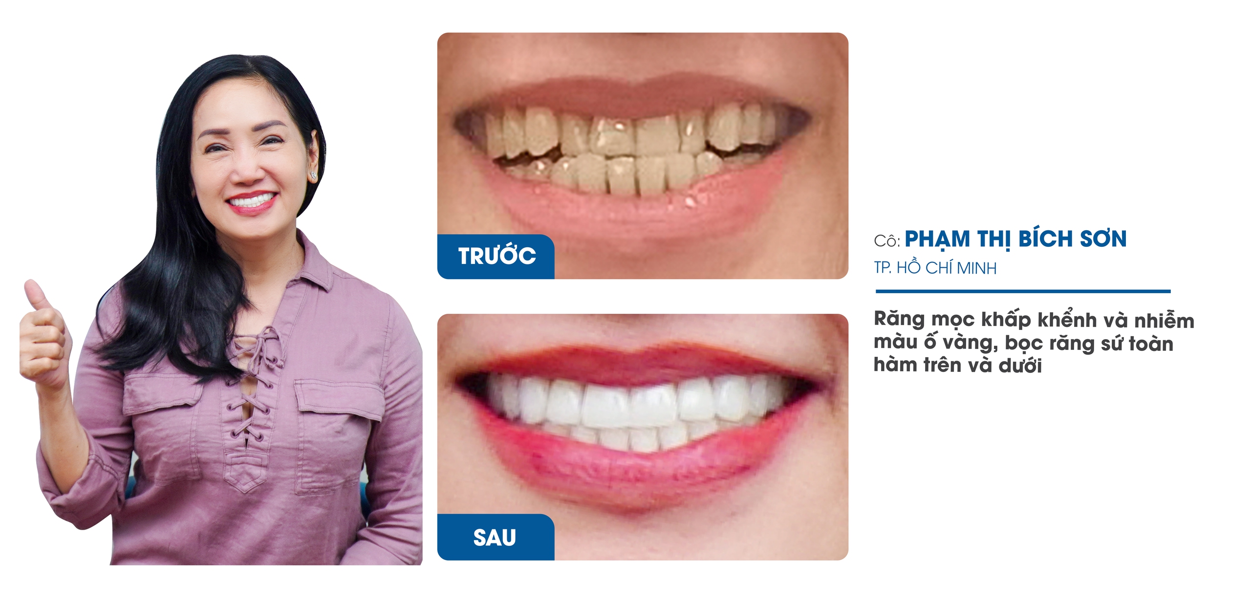 Nha Khoa Răng Sứ I-Dent Diamondtech ứng dụng công nghệ Digital Smile Design trong thiết kế nụ cười- Ảnh 2. Nha Khoa Răng Sứ I-Dent Diamondtech ứng dụng công nghệ Digital Smile Design trong thiết kế nụ cười- Ảnh 2.