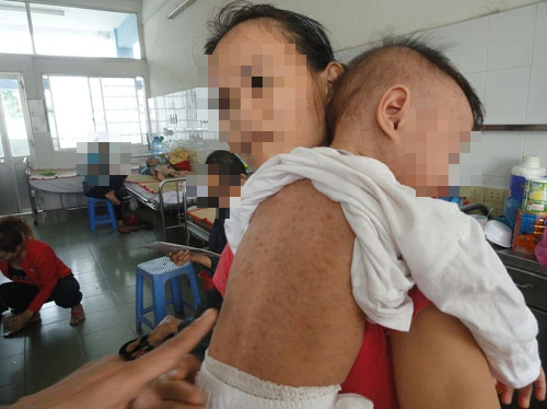 TP.HCM: Nhiều trẻ mắc sởi do cha mẹ ‘quên’ đưa con đi tiêm vắc xin
- Ảnh 1. TP.HCM: Nhiều trẻ mắc sởi do cha mẹ ‘quên’ đưa con đi tiêm vắc xin
- Ảnh 1.