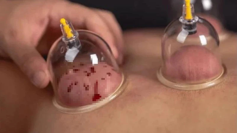 Người đàn ông 35 tuổi đột quỵ sau giác hơi, những ai không nên thực hiện phương pháp này?- Ảnh 2. Người đàn ông 35 tuổi đột quỵ sau giác hơi, những ai không nên thực hiện phương pháp này?- Ảnh 2.