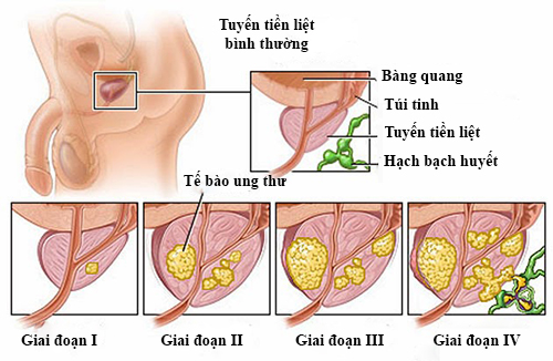 Tại sao tuổi cao trở thành yếu tố nguy cơ của ung thư?- Ảnh 2. Ung thư tuyến tiền liệt - căn bệnh có thể chữa khỏi