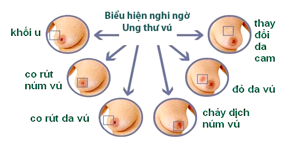 Tại sao tuổi cao trở thành yếu tố nguy cơ của ung thư?- Ảnh 1. Xuất hiện khối ở vú có ý nghĩa gì ? Yếu tố nguy cơ gây Ung thư?