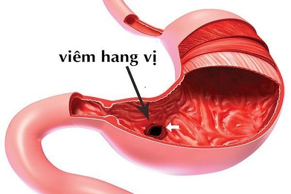 Viêm hang vị dạ dày có nguy hiểm không? - Ảnh 1. Viêm hang vị dạ dày có nguy hiểm không? - Ảnh 1.