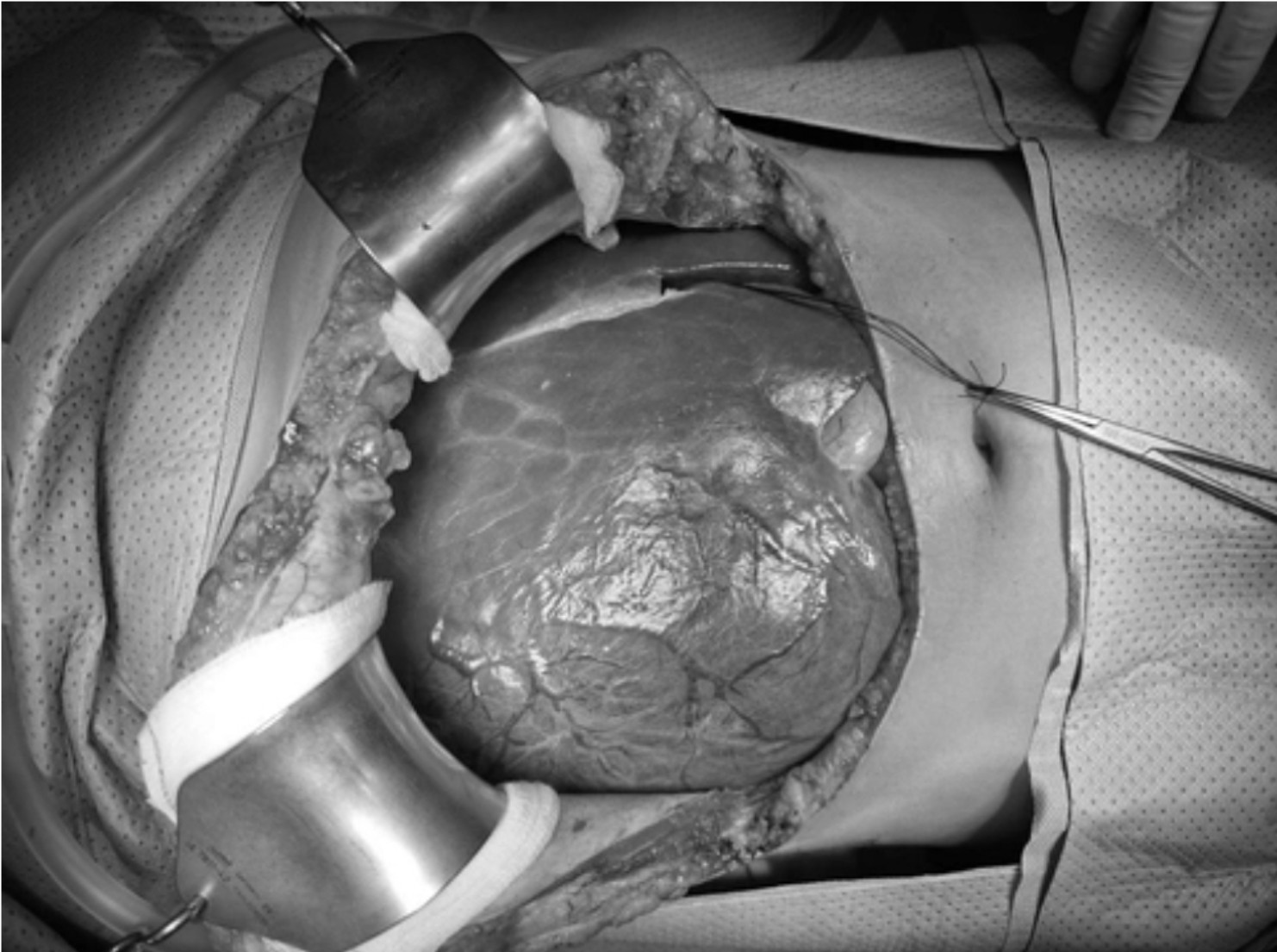 Cứu sống cô gái mang khối u gan khổng lồ hiếm gặp nặng 3kg- Ảnh 1. Cứu sống cô gái mang khối u gan khổng lồ hiếm gặp nặng 3kg- Ảnh 1.