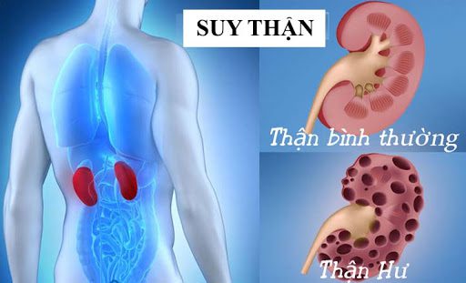 Có 3 dấu hiệu này, thanh niên 24 tuổi ở Phú Thọ đi khám bàng hoàng phát hiện suy thận giai đoạn cuối- Ảnh 4. Có 3 dấu hiệu này, thanh niên 24 tuổi ở Phú Thọ đi khám bàng hoàng phát hiện suy thận giai đoạn cuối- Ảnh 4.