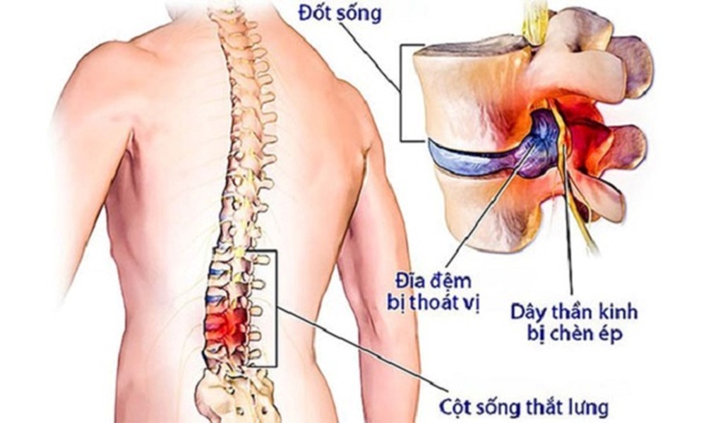 5 lý do gây thoát vị đĩa đệm ai cũng nên biết- Ảnh 2. 5 lý do gây thoát vị đĩa đệm ai cũng nên biết- Ảnh 2.