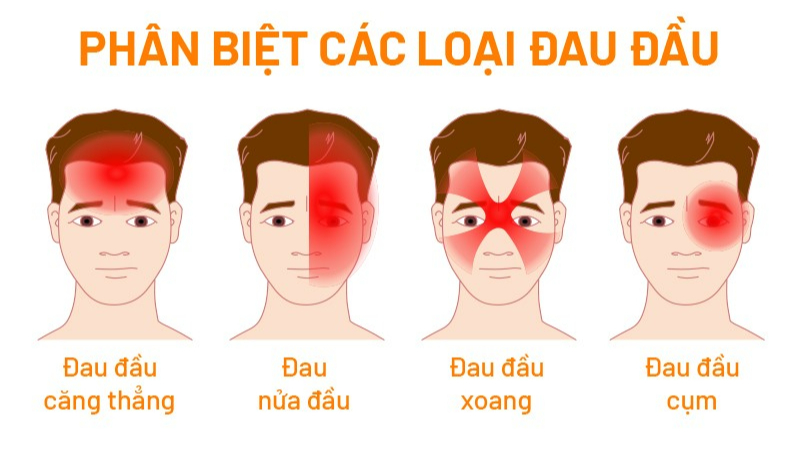 7 cách đơn giản ngăn ngừa đau đầu do căng thẳng- Ảnh 1. bi-dau-dau-01