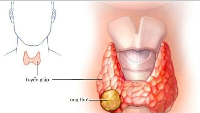 Các dấu hiệu điển hình của ung thư tuyến giáp ai cũng cần biết- Ảnh 1. Các dấu hiệu điển hình của ung thư tuyến giáp ai cũng cần biết- Ảnh 1.