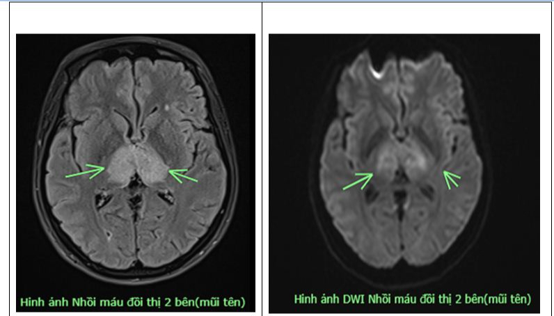 Đau đầu 4 ngày uống thuốc không đỡ, người phụ nữ 38 tuổi mắc bệnh nguy hiểm ở não- Ảnh 1. Đau đầu 4 ngày uống thuốc không đỡ, người phụ nữ 38 tuổi mắc bệnh nguy hiểm ở não- Ảnh 1.