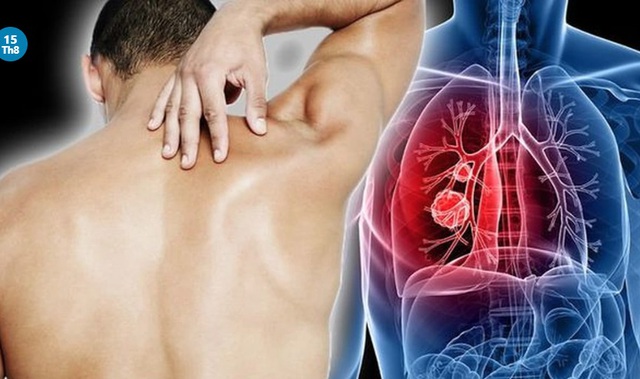 Người đàn ông 29 tuổi bất ngờ phát hiện ung thư phổi, thừa nhận có một sai lầm nhiều nam giới Việt mắc phải - Ảnh 2. Người đàn ông 29 tuổi bất ngờ phát hiện ung thư phổi, thừa nhận có một sai lầm nhiều nam giới Việt mắc phải - Ảnh 2.
