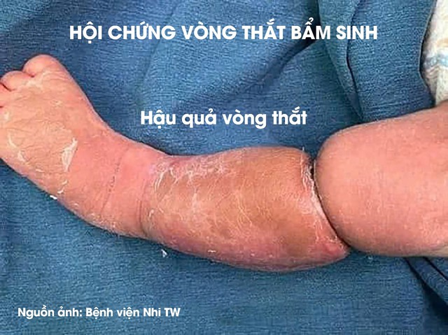 Có ngấn ở chân, bố mẹ ở Phú Thọ tưởng con bụ bẫm, nào ngờ đi khám phát hiện mắc hội chứng vòng thắt bẩm sinh - Ảnh 3. Có ngấn ở chân, bố mẹ ở Phú Thọ tưởng con bụ bẫm, nào ngờ đi khám phát hiện mắc hội chứng vòng thắt bẩm sinh - Ảnh 3.