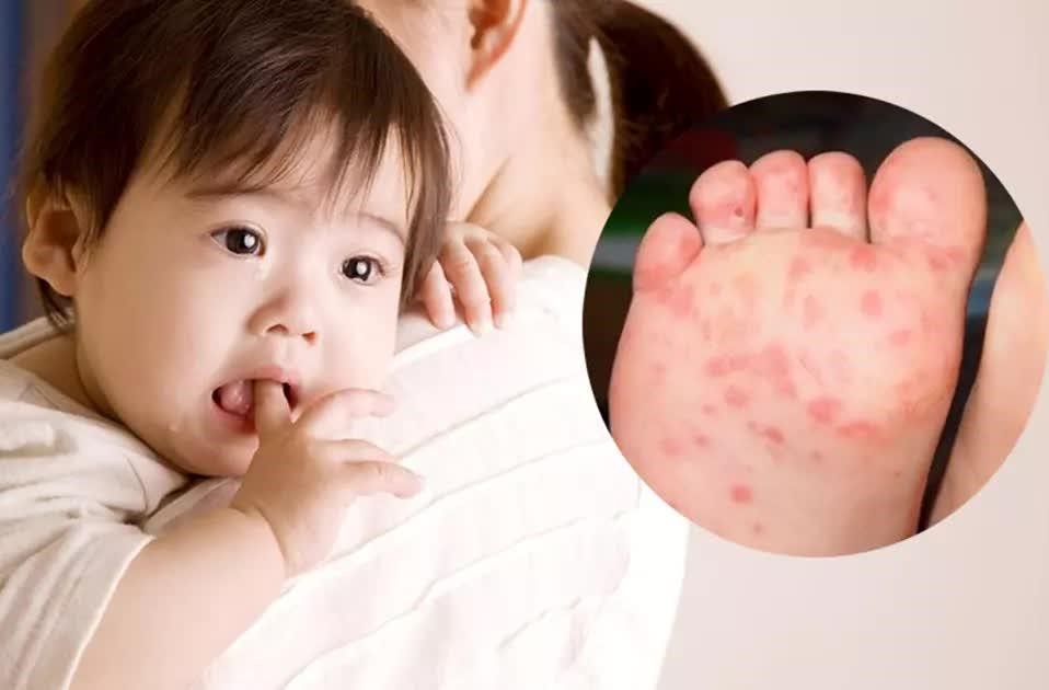 Các con đường lây nhiễm bệnh tay chân miệng là gì?- Ảnh 2. Các con đường lây nhiễm bệnh tay chân miệng là gì?- Ảnh 2.
