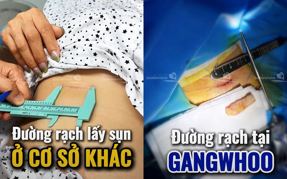 Nâng mũi sụn sườn tự thân nội soi vi phẫu - mũi đẹp an toàn bền vững- Ảnh 2. Nâng mũi sụn sườn tự thân nội soi vi phẫu - mũi đẹp an toàn bền vững- Ảnh 2.