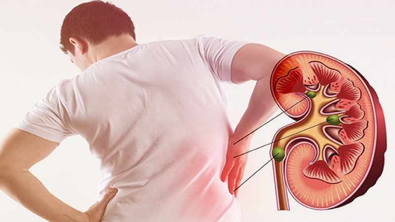 6 nguyên nhân gây sỏi thận nhiều người mắc phải- Ảnh 2. 6 nguyên nhân gây sỏi thận nhiều người mắc phải- Ảnh 2.