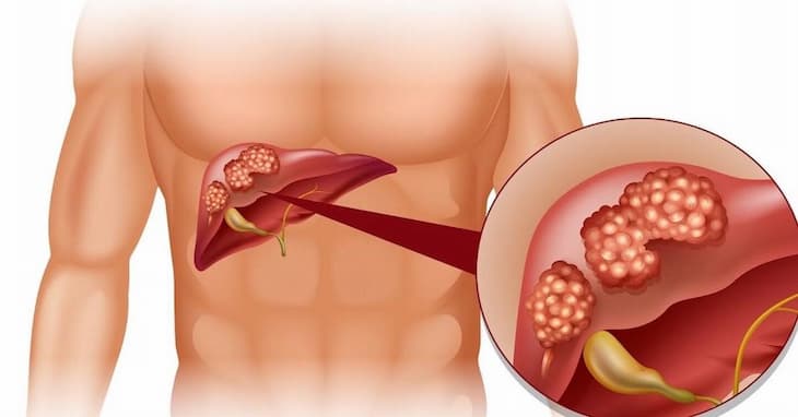 Cách giảm thiểu nguy cơ nhiễm độc gan- Ảnh 1. Cách giảm thiểu nguy cơ nhiễm độc gan- Ảnh 1.