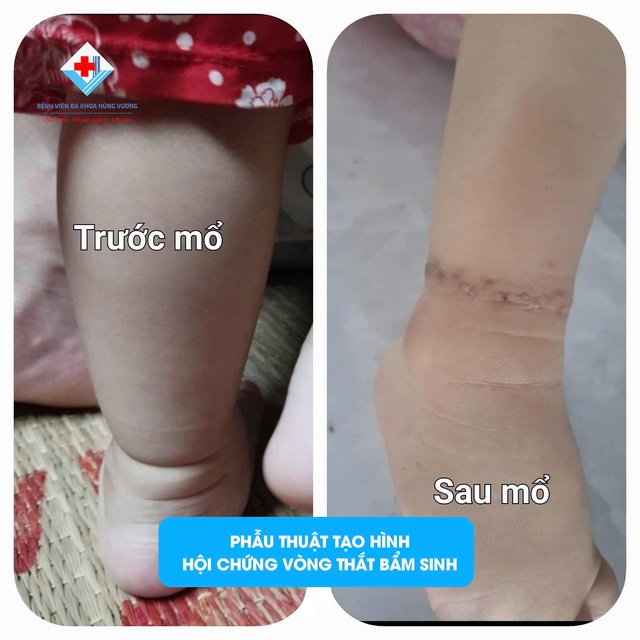 Có ngấn ở chân, bố mẹ ở Phú Thọ tưởng con bụ bẫm, nào ngờ đi khám phát hiện mắc hội chứng vòng thắt bẩm sinh - Ảnh 2. Có ngấn ở chân, bố mẹ ở Phú Thọ tưởng con bụ bẫm, nào ngờ đi khám phát hiện mắc hội chứng vòng thắt bẩm sinh - Ảnh 2.