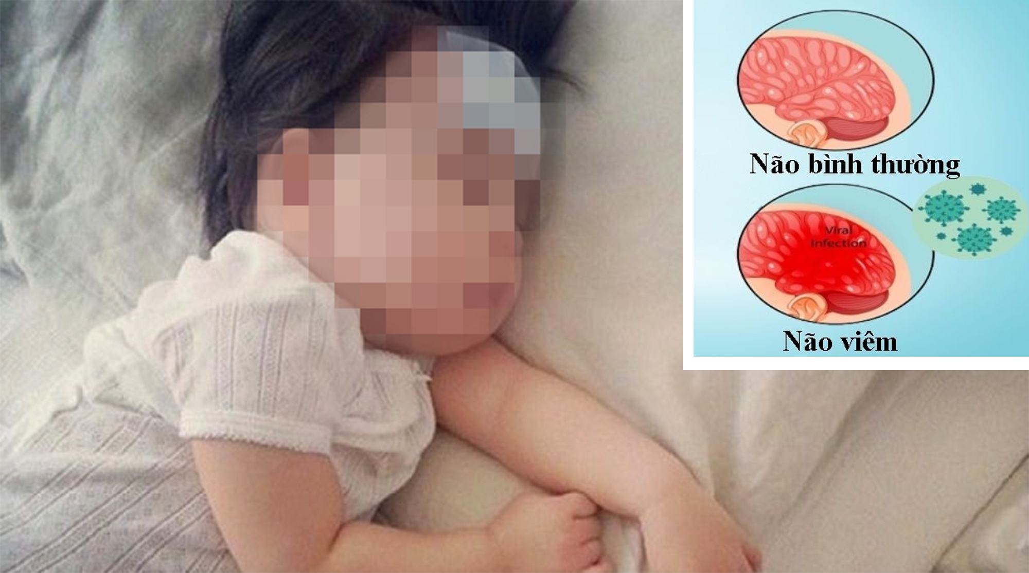 Dấu hiệu nhận biết viêm màng não ở trẻ em- Ảnh 1. Dấu hiệu nhận biết viêm màng não ở trẻ em- Ảnh 1.