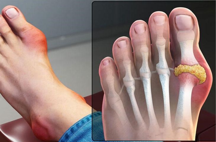 Điều trị bệnh gout cần lưu ý 3 điều sau- Ảnh 2. Điều trị bệnh gout cần lưu ý 3 điều sau- Ảnh 2.
