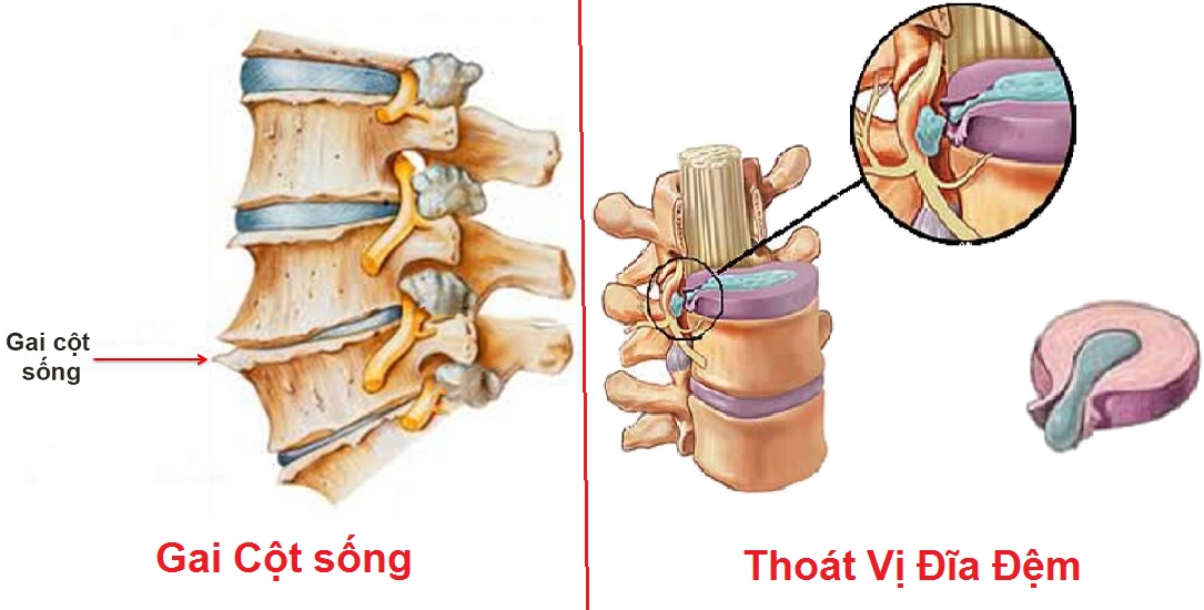 Thoát vị đĩa đệm là tình trạng nhân nhầy đĩa đệm ở giữa các đốt sống thoát ra khỏi những thớ sợi bao quanh bên ngoài. Thoát vị đĩa đệm là tình trạng nhân nhầy đĩa đệm ở giữa các đốt sống thoát ra khỏi những thớ sợi bao quanh bên ngoài.