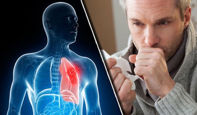 Người đàn ông 38 tuổi ở Phú Thọ đau họng, ho ra máu thừa nhận một sai lầm mà nhiều nam giới Việt mắc phải - Ảnh 2. Người đàn ông 38 tuổi ở Phú Thọ đau họng, ho ra máu thừa nhận một sai lầm mà nhiều nam giới Việt mắc phải - Ảnh 2.