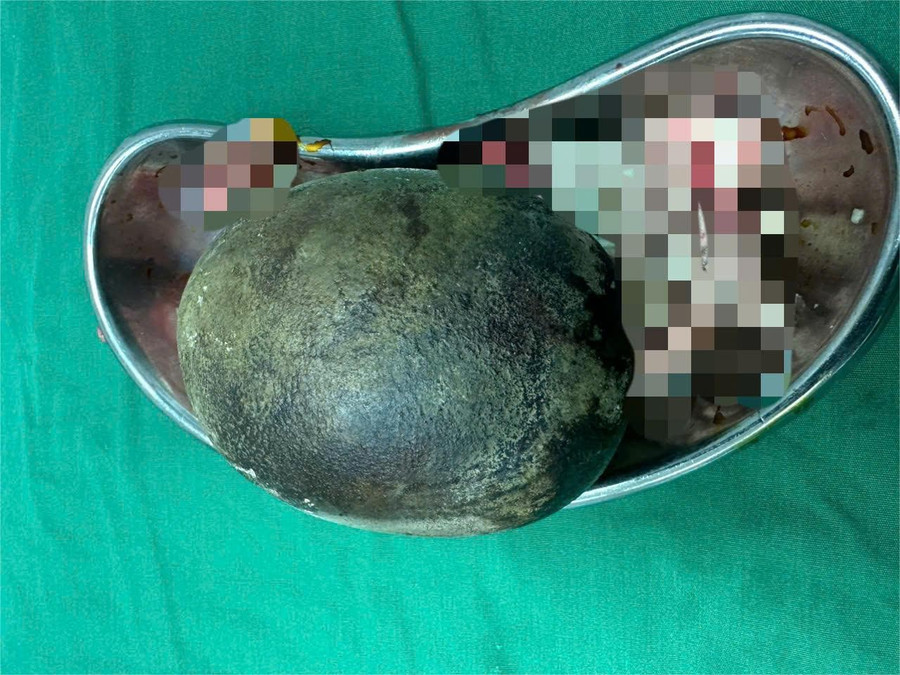 Người đàn ông 45 tuổi mang viên sỏi nặng 700g ở bàng quang, nguyên nhân gây bệnh rất nhiều người Việt hay mắc phải- Ảnh 1. Người đàn ông 45 tuổi mang viên sỏi nặng 700g ở bàng quang, nguyên nhân gây bệnh rất nhiều người Việt hay mắc phải- Ảnh 1.