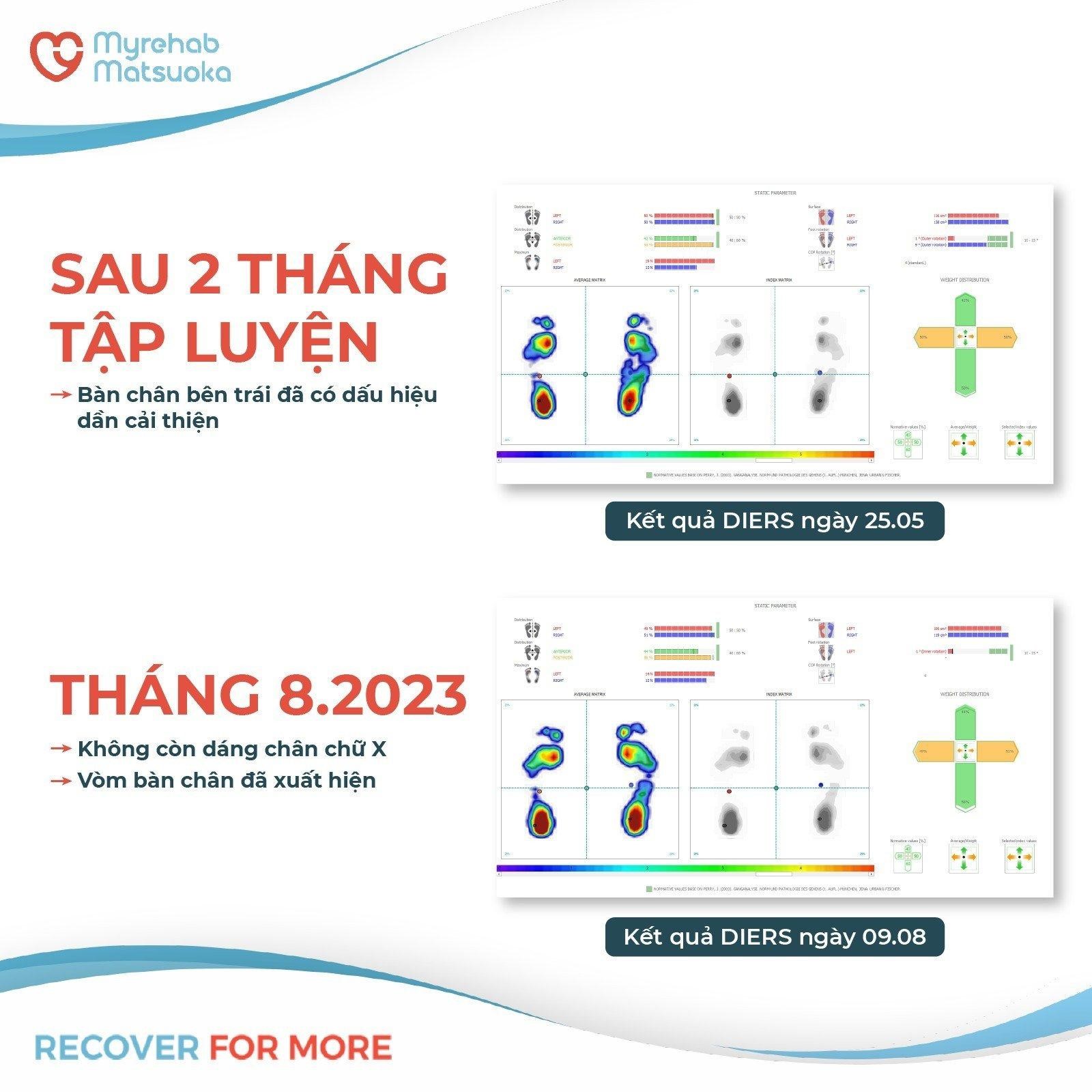Phục hồi chức năng bàn chân bẹt cho người trên 7 tuổi khó nhưng có thể thành công mà không cần phẫu thuật - Ảnh 1. Phục hồi chức năng bàn chân bẹt cho người trên 7 tuổi khó nhưng có thể thành công mà không cần phẫu thuật - Ảnh 1.