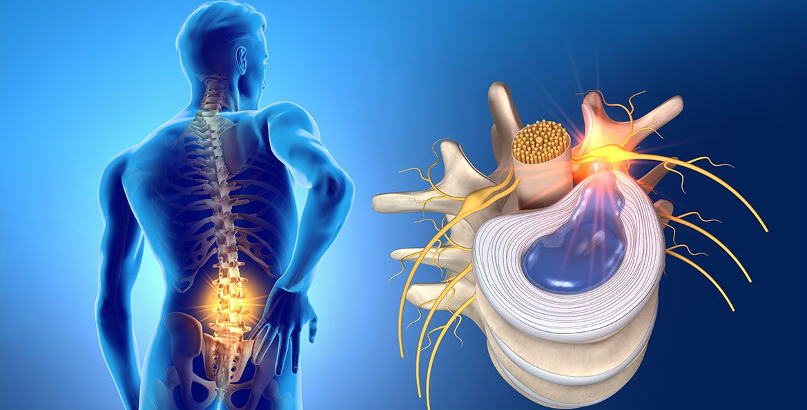 Thoát vị đĩa đệm do những thói quen bạn ít ngờ đến- Ảnh 2. Thoát vị đĩa đệm do những thói quen bạn ít ngờ đến- Ảnh 2.