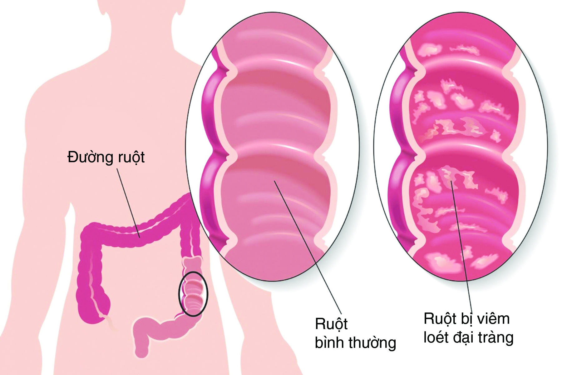 Viêm đại tràng mạn tính có nguy hiểm không?- Ảnh 1. Viêm đại tràng mạn tính có nguy hiểm không?- Ảnh 1.