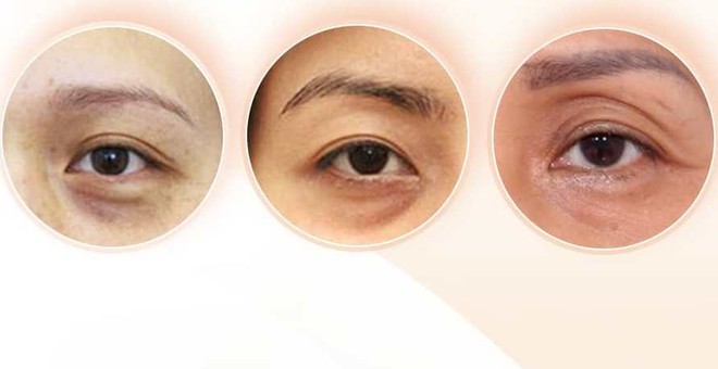 Bí mật đằng sau bọng mắt và quầng thâm đen dưới mắt- Ảnh 3. Bí mật đằng sau bọng mắt và quầng thâm đen dưới mắt- Ảnh 3.