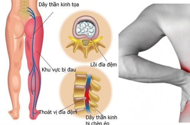 Bé 13 tuổi ở Sơn La nhập viện gấp sau khi dọn thóc giúp cha mẹ, bác sĩ chỉ rõ nguyên nhân người Việt mắc phải - Ảnh 4. Bé 13 tuổi ở Sơn La nhập viện gấp sau khi dọn thóc giúp cha mẹ, bác sĩ chỉ rõ nguyên nhân người Việt mắc phải - Ảnh 4.