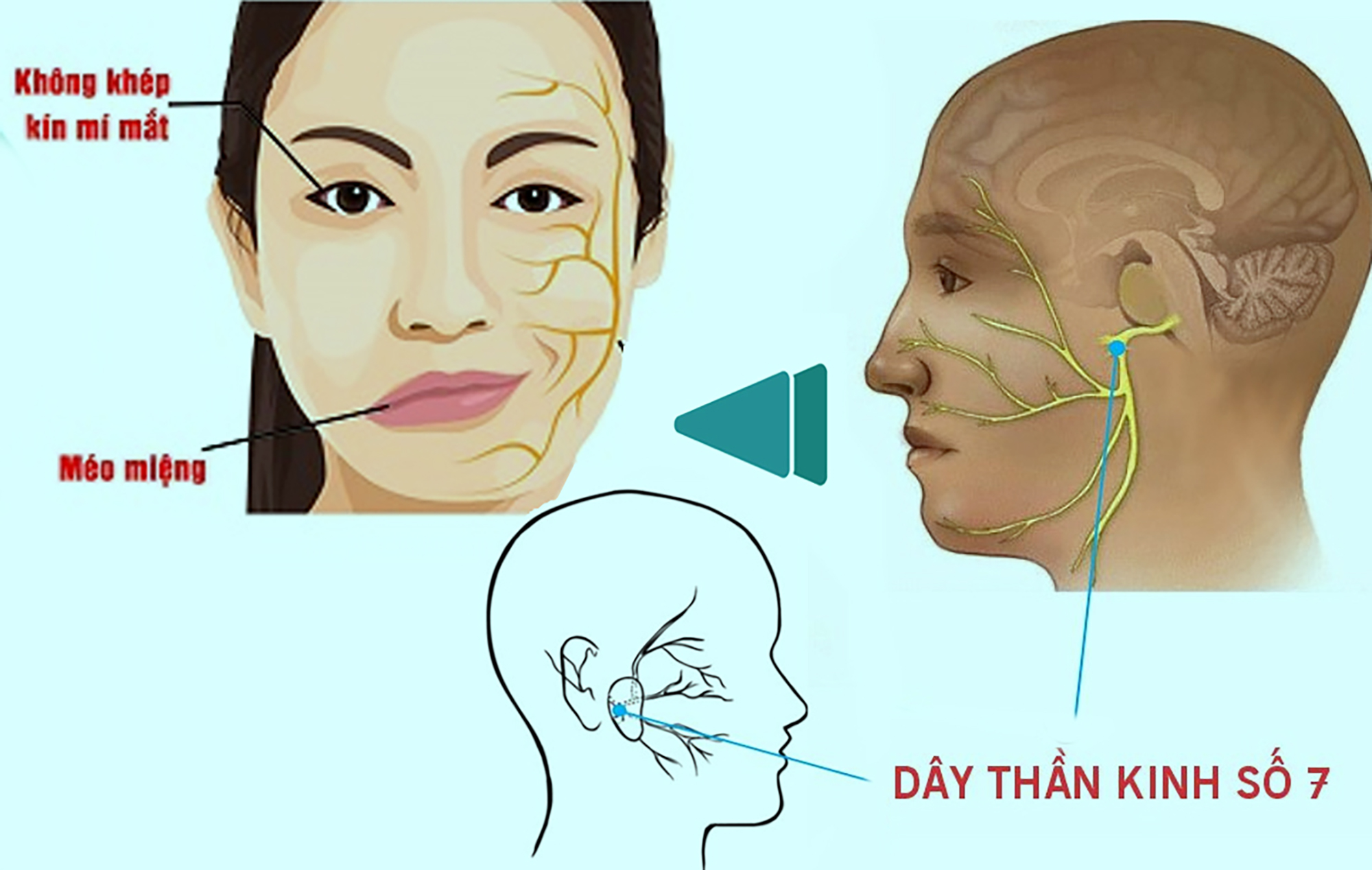 Liệt dây thần kinh số 7 có phục hồi được không?- Ảnh 1. Liệt dây thần kinh số 7 có phục hồi được không?- Ảnh 1.