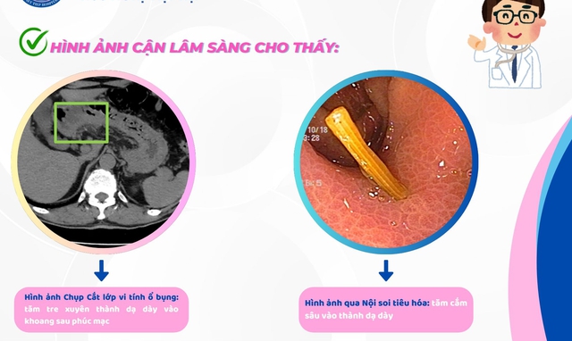 Người đàn ông ở Hải Phòng bị thủng dạ dày, thừa nhận một sai lầm mà nhiều người Việt mắc phải - Ảnh 2. Người đàn ông ở Hải Phòng bị thủng dạ dày, thừa nhận một sai lầm mà nhiều người Việt mắc phải - Ảnh 2.
