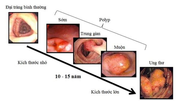 Người đàn ông ở Phú Thọ phát hiện mắc ung thư trực tràng từ một dấu hiệu nhiều người Việt bỏ qua- Ảnh 2. Người đàn ông ở Phú Thọ phát hiện mắc ung thư trực tràng từ một dấu hiệu nhiều người Việt bỏ qua- Ảnh 2.
