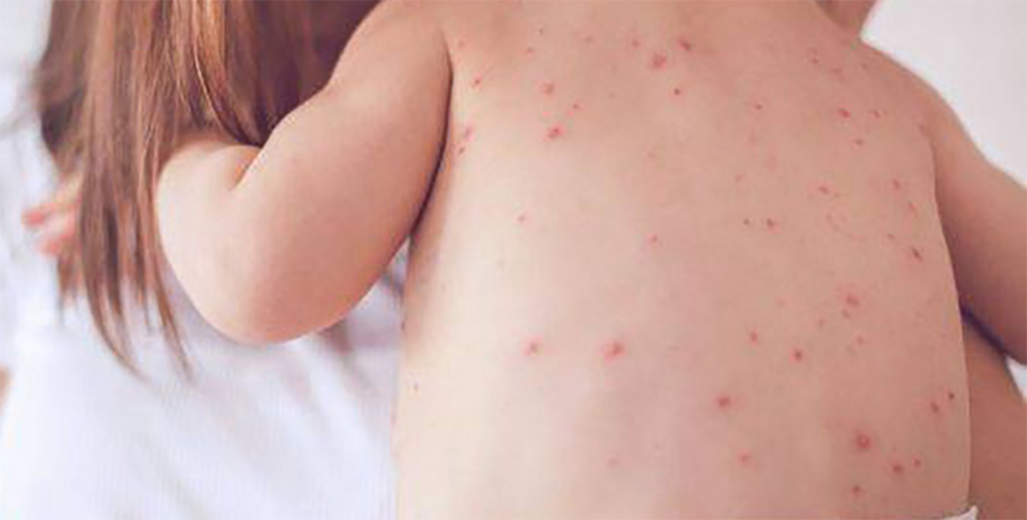 Trẻ bị sởi có cần kiêng gió, kiêng nước?- Ảnh 1. Trẻ bị sởi có cần kiêng gió, kiêng nước?- Ảnh 1.