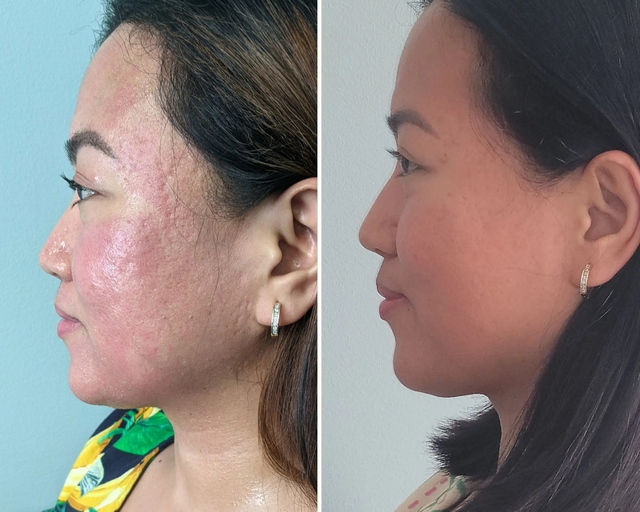 'Cứu' làn da bị sẹo lõm với công nghệ RF Microneedling- Ảnh 4. 'Cứu' làn da bị sẹo lõm với công nghệ RF Microneedling- Ảnh 4.