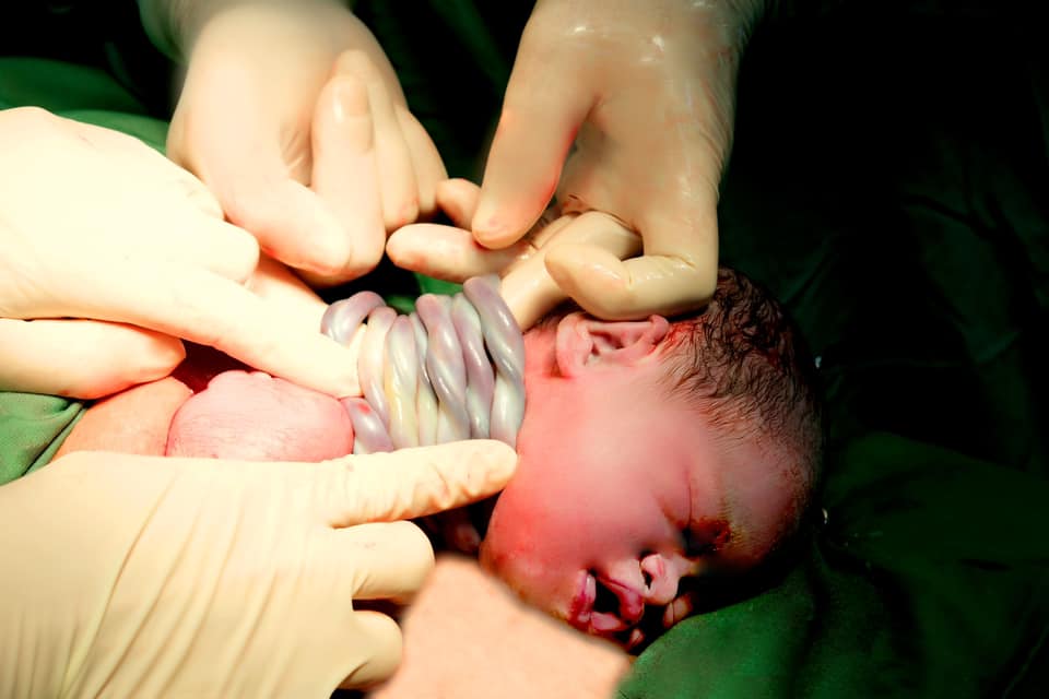 Hi hữu: Bé gái chào đời với 9 vòng dây rốn quấn quanh cổ- Ảnh 1. Hi hữu: Bé gái chào đời với 9 vòng dây rốn quấn quanh cổ- Ảnh 1.
